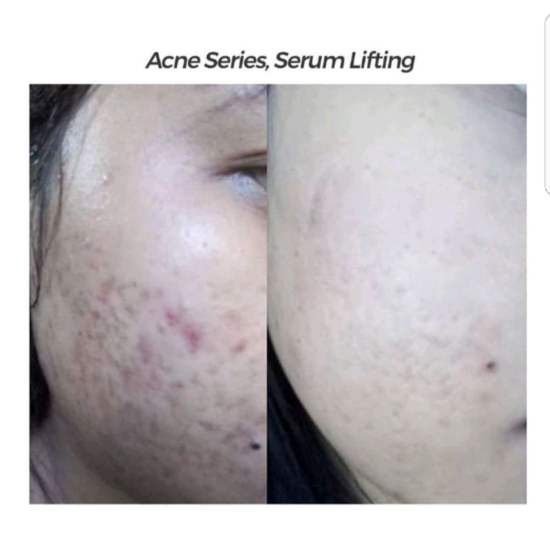 Paket Acne + Serum Lifting MS GLOW