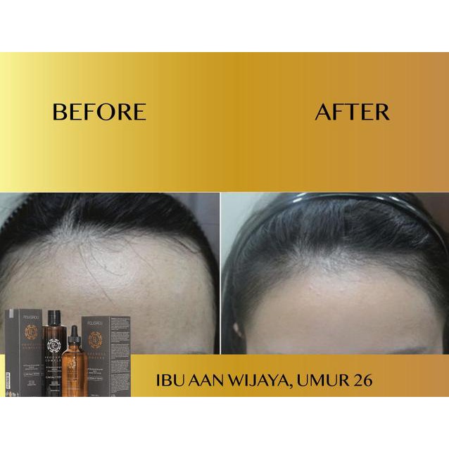 FOLIGROU HAIR TONIC SERUM PENUMBUH RAMBUT