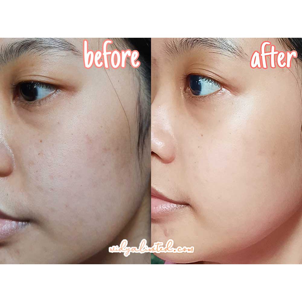 Scarlett  READYY Whitening Acne Serum