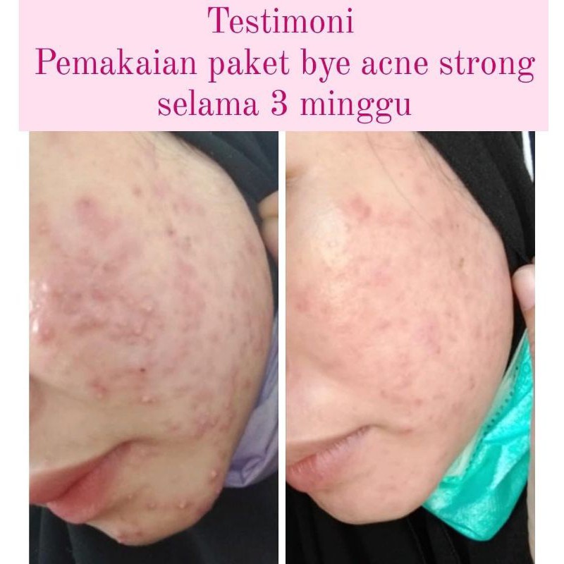 VAVL PAKET BYE ACNE STRONG FREE POUCH + FREE GIFT