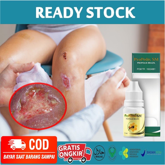 Obat Penyembuhan Luka, Luka Bernanah,Borok, Koreng, Luka Diabetes, Eksim, Luka Gangren - Propolis SM