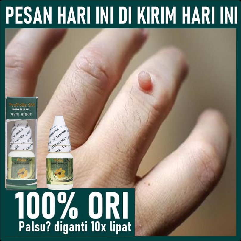 Obat Kutil di Tangan - Penghilang Kutil di Tangan - Obat Oles daging tumbuh / Skin tag di Tangan