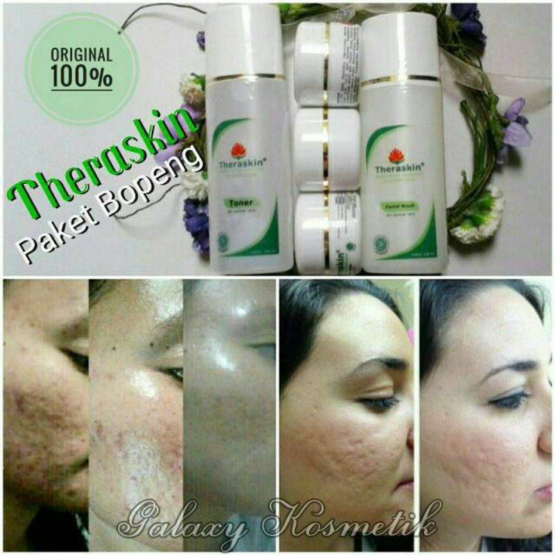CREAM THERASKIN - PAKET BOPENG / SCAR - UNTUK WAJAH BERLUBANG - ORIGINAL 100%