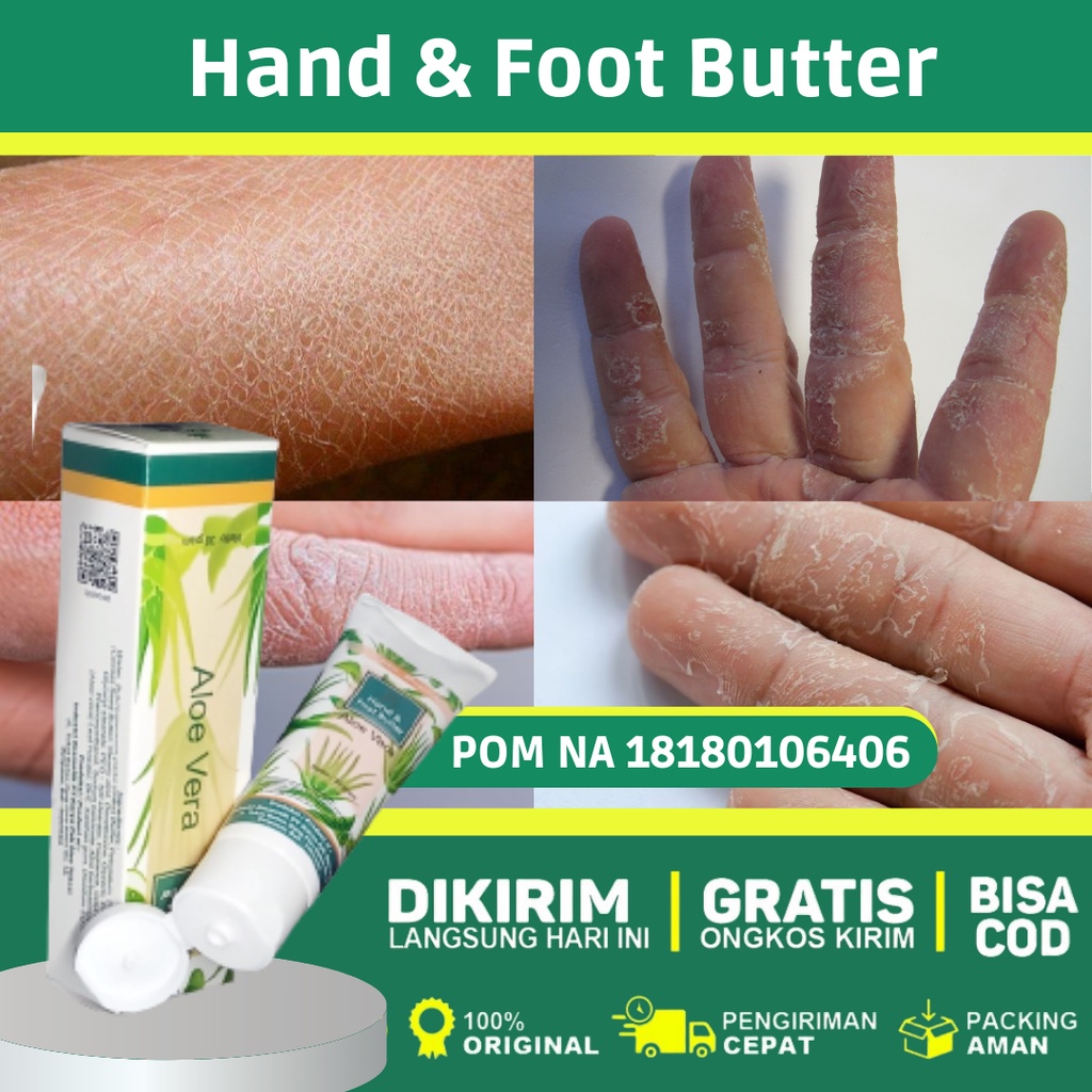 Obat Kulit Tangan Kering, Telapak Tangan Mengelupas, Krim Tangan Pecah, Kering, Bersisik, Mengelupas