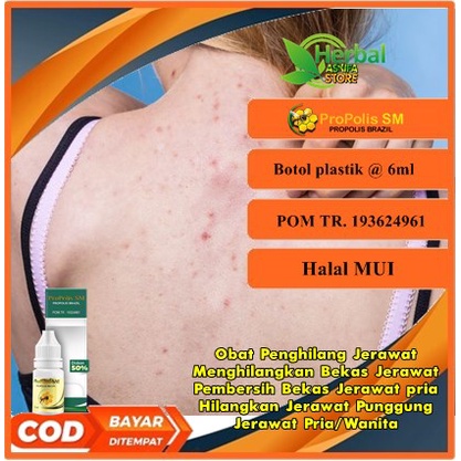 Obat Penghilang Jerawat, Menghilangkan Bekas Jerawat, Pembersih Bekas Jerawat pria, Hilangkan Jerawa