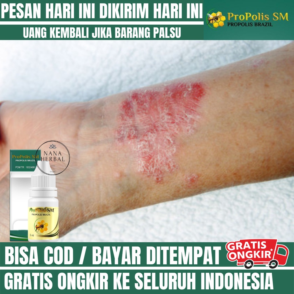 Obat Iritasi Kulit, Obat Oles Kulit Perih karena Iritasi, Iritasi Kulit Bayi, Obat Kulit Lecet, Rada