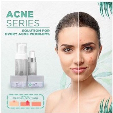 Ms Glow Original Acne Series