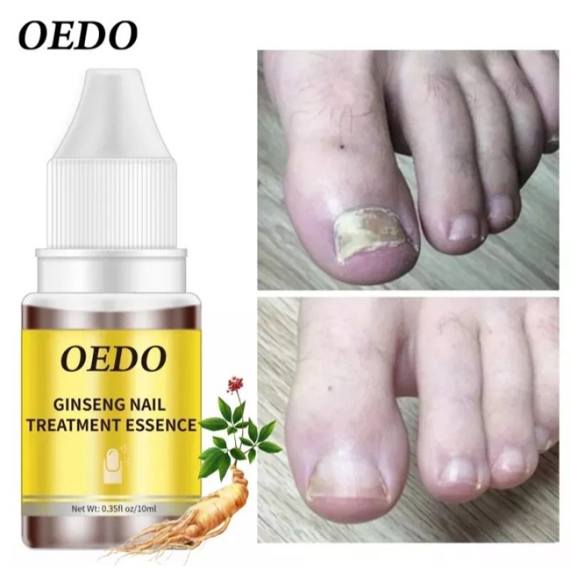 OEDO TREATMENT KUKU ANTI BAKTERI, PERBAIKAN KUKU