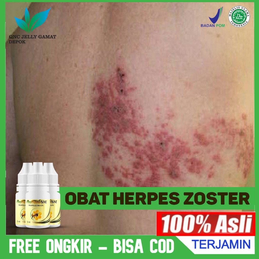 Obat Herpes Zoster, Herpes Simplex di Bibir, Leher Herbal Propolis SM Original - Murah Bisa COD