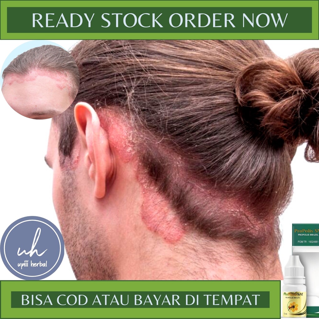 Obat Psoriasis Kepala, Obat Jamur Di Kepala, Obat Kepala Gatal, Obat Kulit Menebal Dan Gatal, Obat O