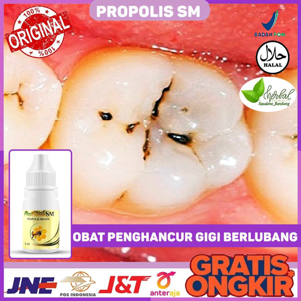 Obat Penghancur Gigi Berlubang, Obat Gigi Berlubang Sakit, Obat Gigi Berlubang Bau, Obat Gigi Berlub