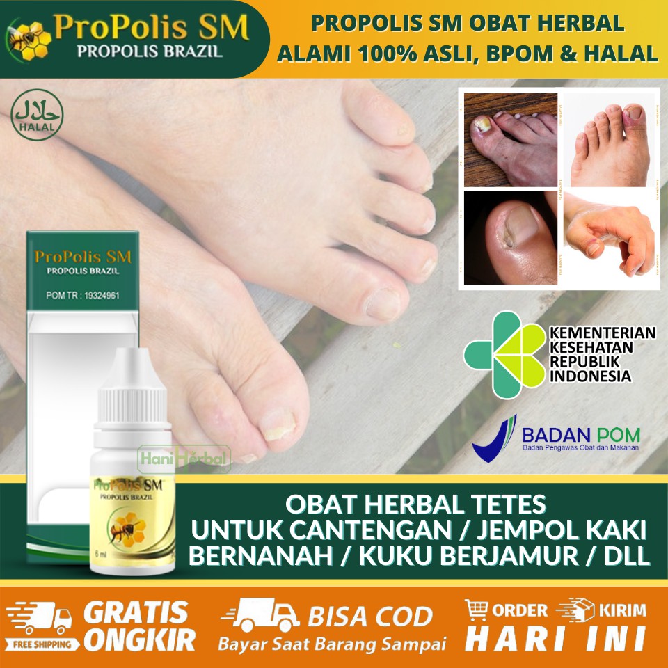 Obat Cantengan Alami 100 Obat Cantengan Kuku Cantengan Di Jempol Kaki Walatra Propolis Brazil Shopee Indonesia