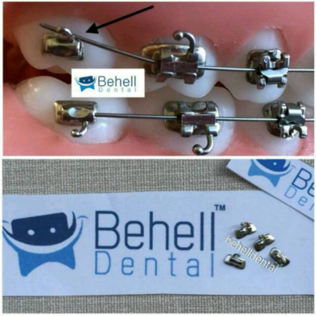 BUCCAL TUBE PENGUNCI BEHEL BRACKET KAWAT GIGI GERAHAM M1 M2 ROTH BUCAL FDA - First Molar - Second Molar - DENTAL ORTHO ORIGINAL BEHELLDENTAL