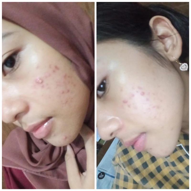 Paket Acne Colista Skin Care BPOM-5