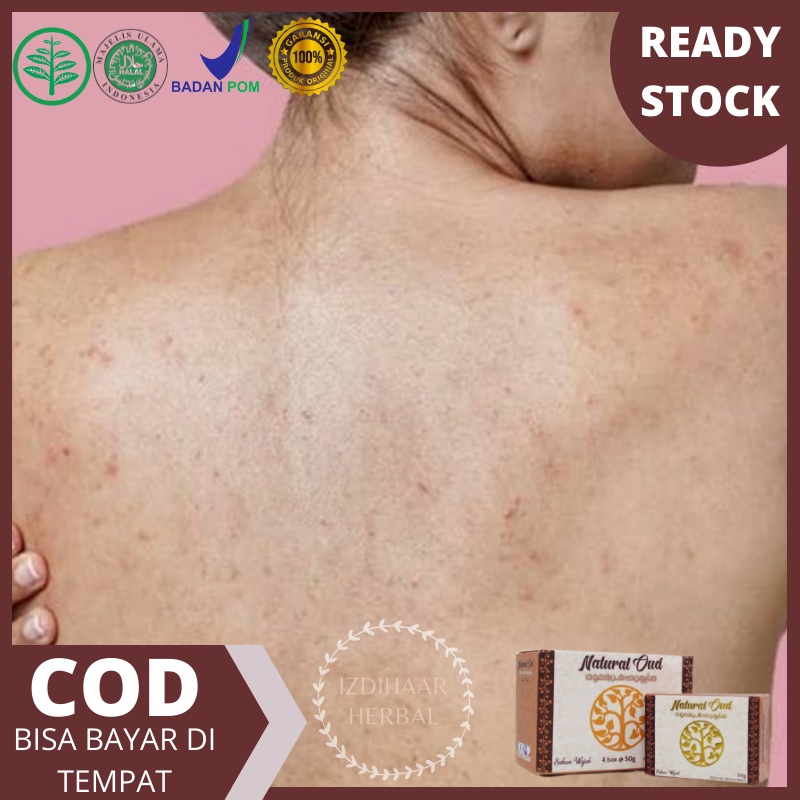 Sabun penghilang jerawat punggung - Sabun Jerawat punggung - Obat jerawat punggung - obat penghilang