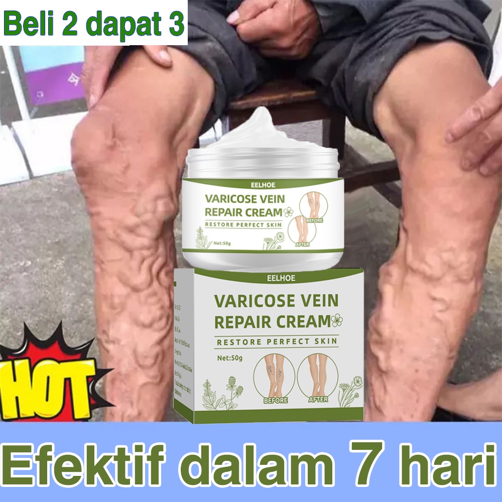 Obat Varises Salep Varises Cream Varicose Veins Varikokel Bengkak Benjolan Buah Zakar Nyeri Testis Vaskulitis Flebitis Pengobatan Vaskulitis Salep