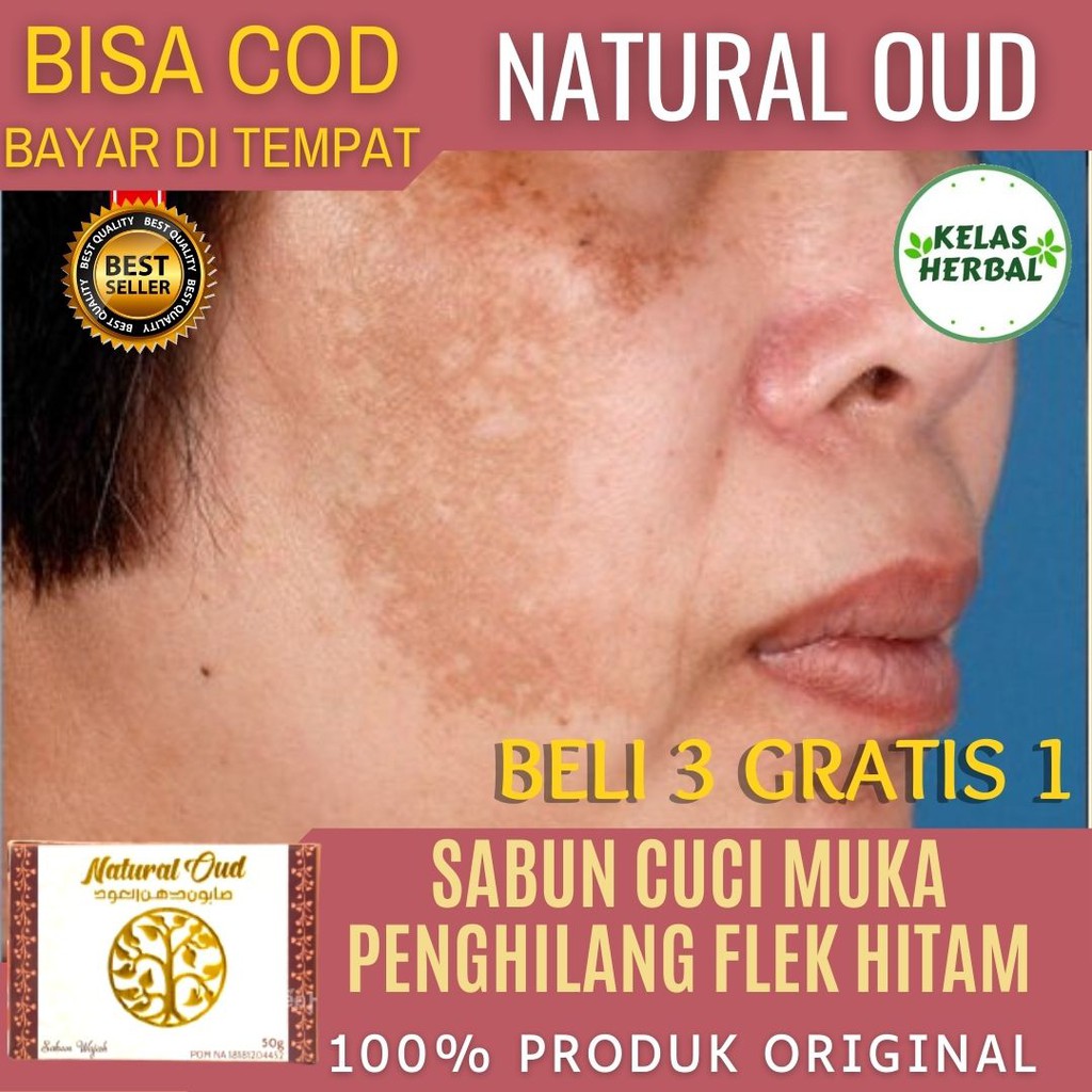 Jual Sabun Wajah Menghilangkan Flek Hitam Bercak Noda Hitam Freckles ...