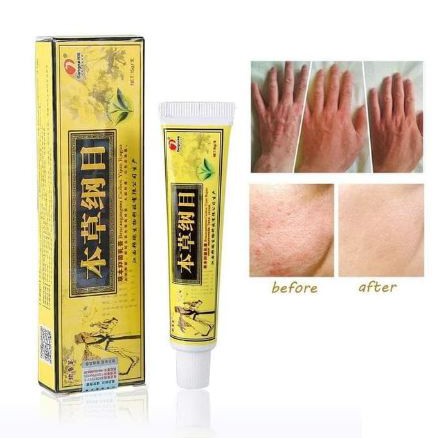 Obat Gatal Salep Eksim Psoriasis Efektif Untuk Kesehatan Kulit Gatal Ampuh SALEP KUNING-2