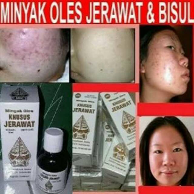 MINYAK OLES KHUSUS JERAWAT - MINYAK OLES OBAT JERAWAT CAP WAYANG ORIGINAL