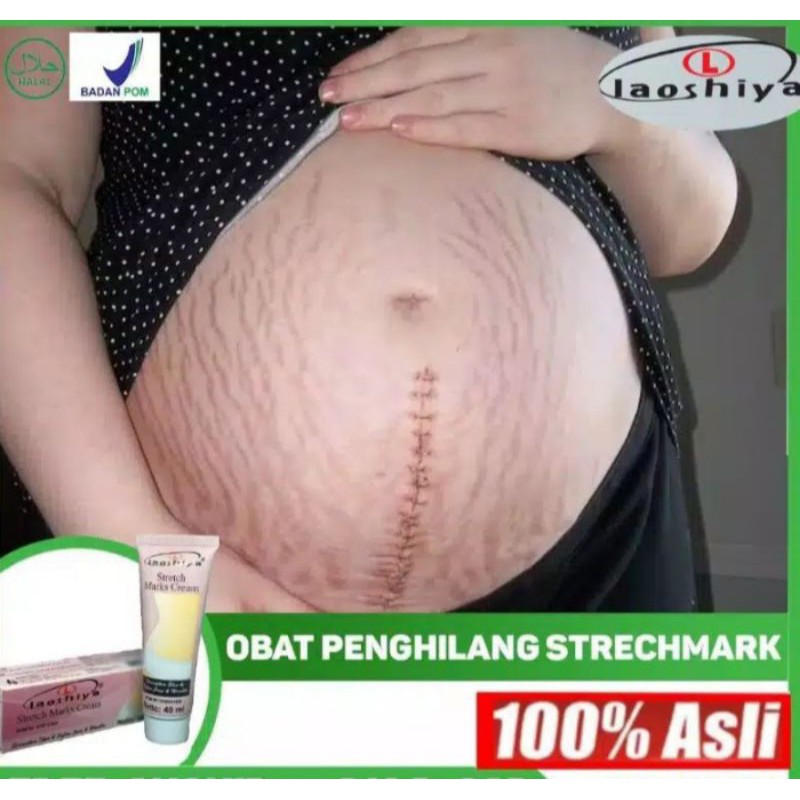 Laoshiya Stretch Mark Cream Sangat Ampuh Atasi Stretch Mark Original BPOM