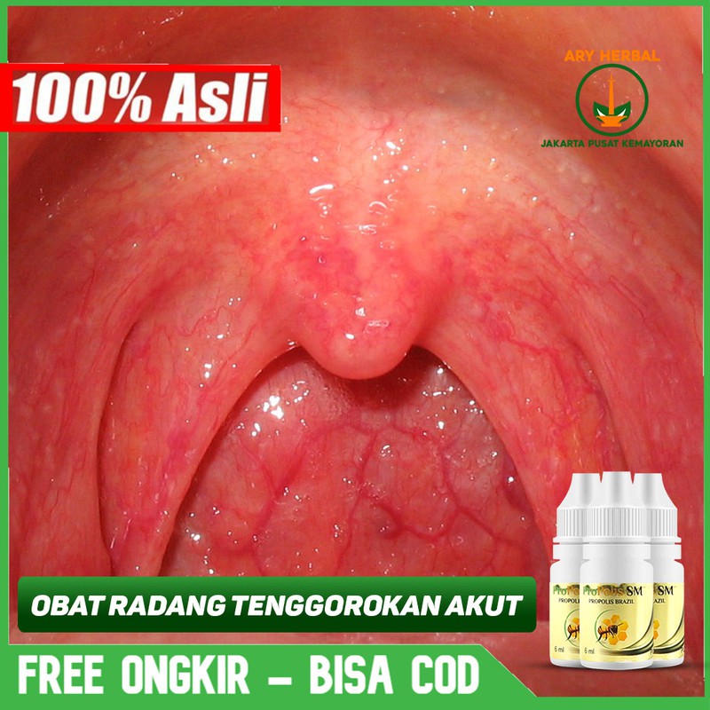 

Obat Radang Tenggorokan Akut, Kronis, Alami Herbal Terlaris Propolis SM Bisa COD