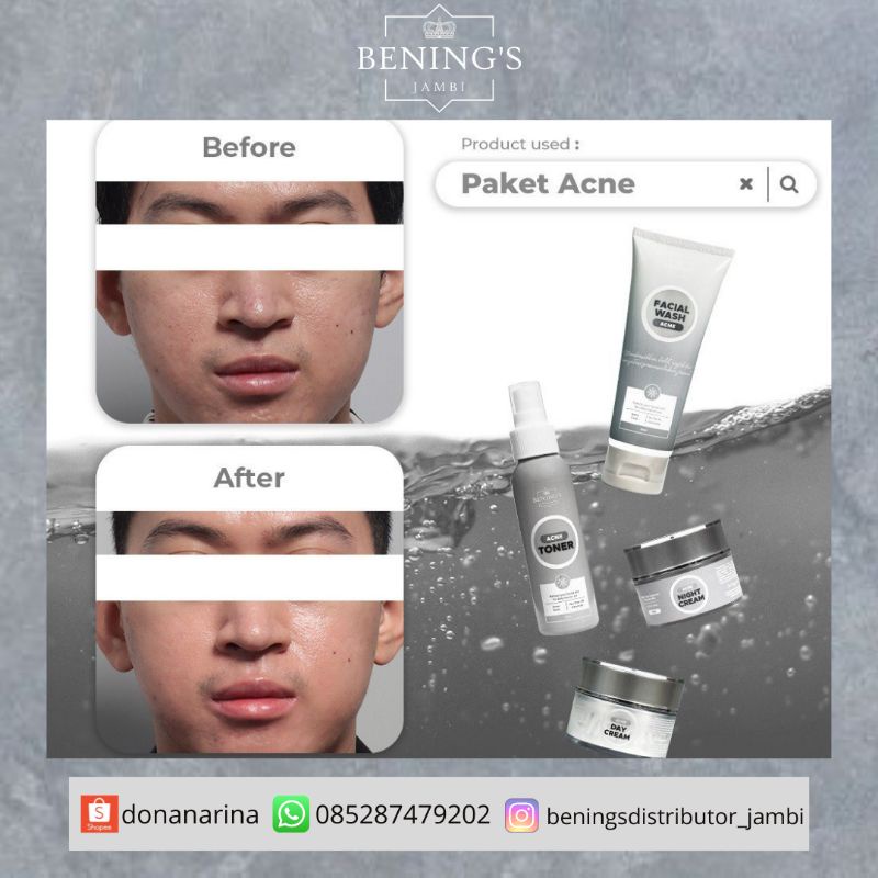 Benings Skincare Acne Dr. Oky Pratama / Bening’s Indonesia / Bening’s Clinic