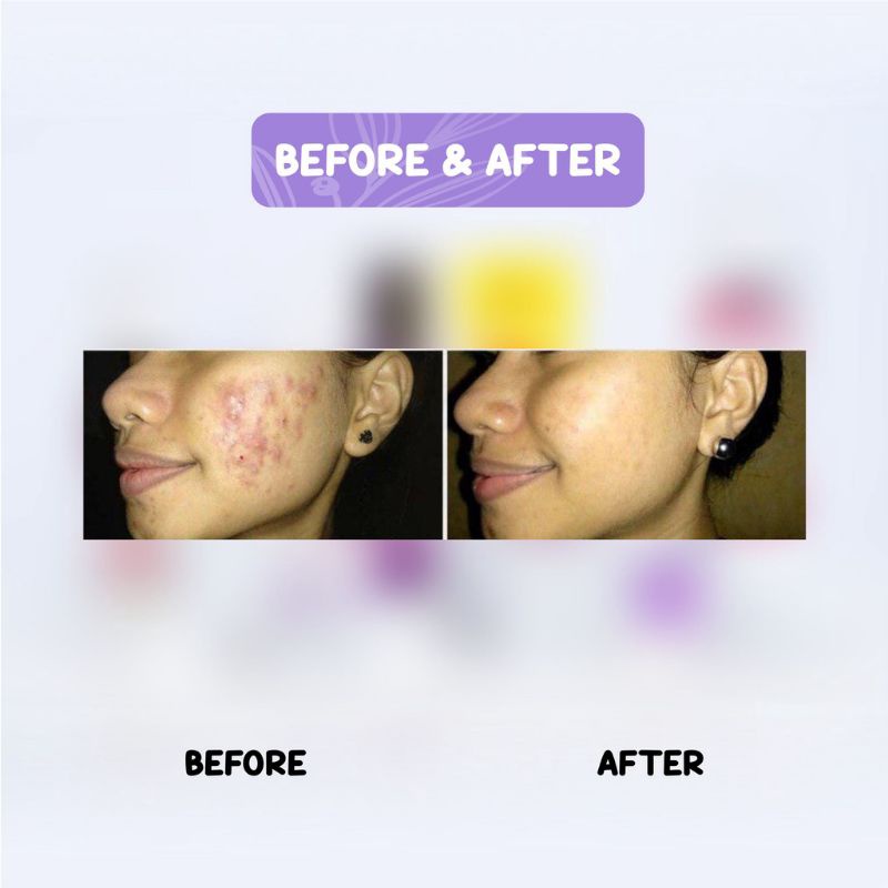 Paket acne Glafidsya Skin care