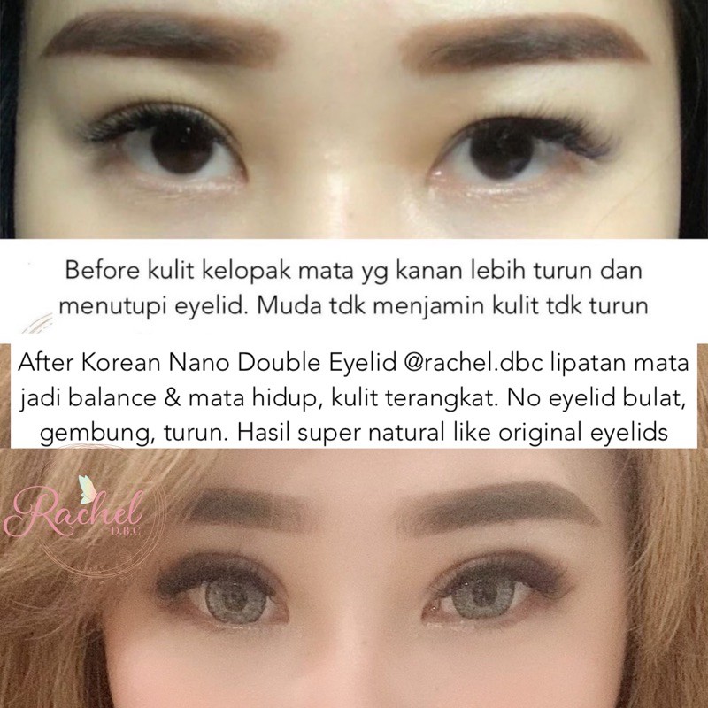 

Korean Nano Double Eyelid