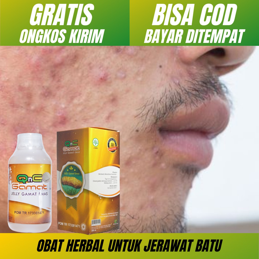 [MUJARAB] Obat Untuk Jerawat Batu_Penghilang Bekas Jerawat_Jerawat Menahun_Obat Jerawat Pria Wanita