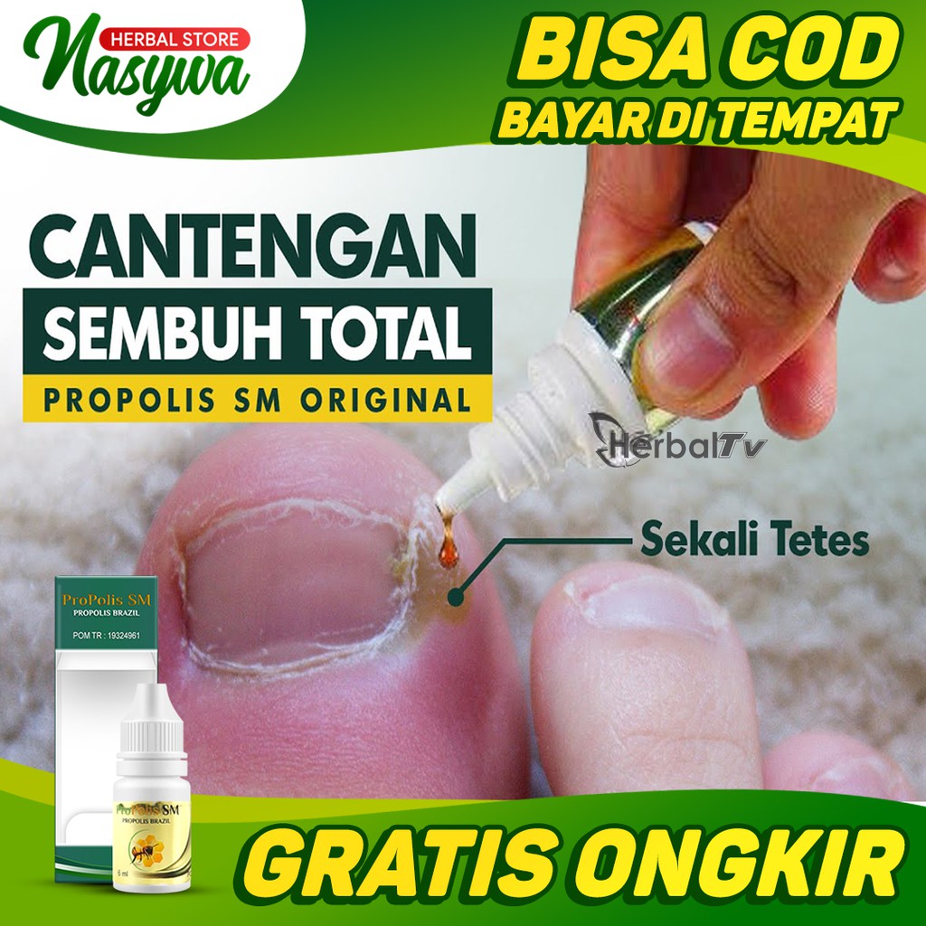 Obat Kuku Jempol Kaki Cantengan Propolis Sm Obat Kuku Rusak Herbal Busuk Bernanah Bengkak Shopee Indonesia