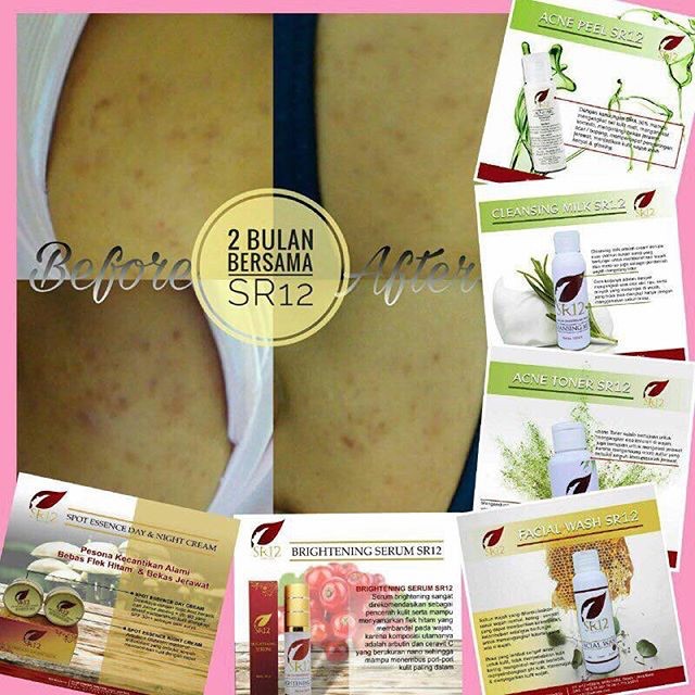 CHEMICAL PEELING ACNE SR12 - ACNE PEEL SOLUSI BOPENG SCAR BHA 30% HILANGKA BEKAS JERAWAT dan bruntus