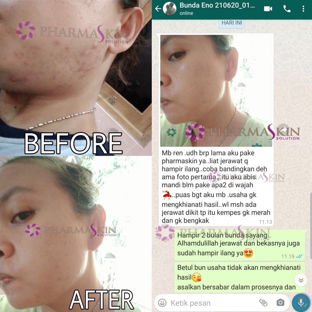 Pharmaskin Paket Full Treatment Acne Glowing Series Bebas Menghilangkan Jerawat Perawatan Wajah Berjerawat Glowing Ampuh Resmi BPOM Halal Original-1