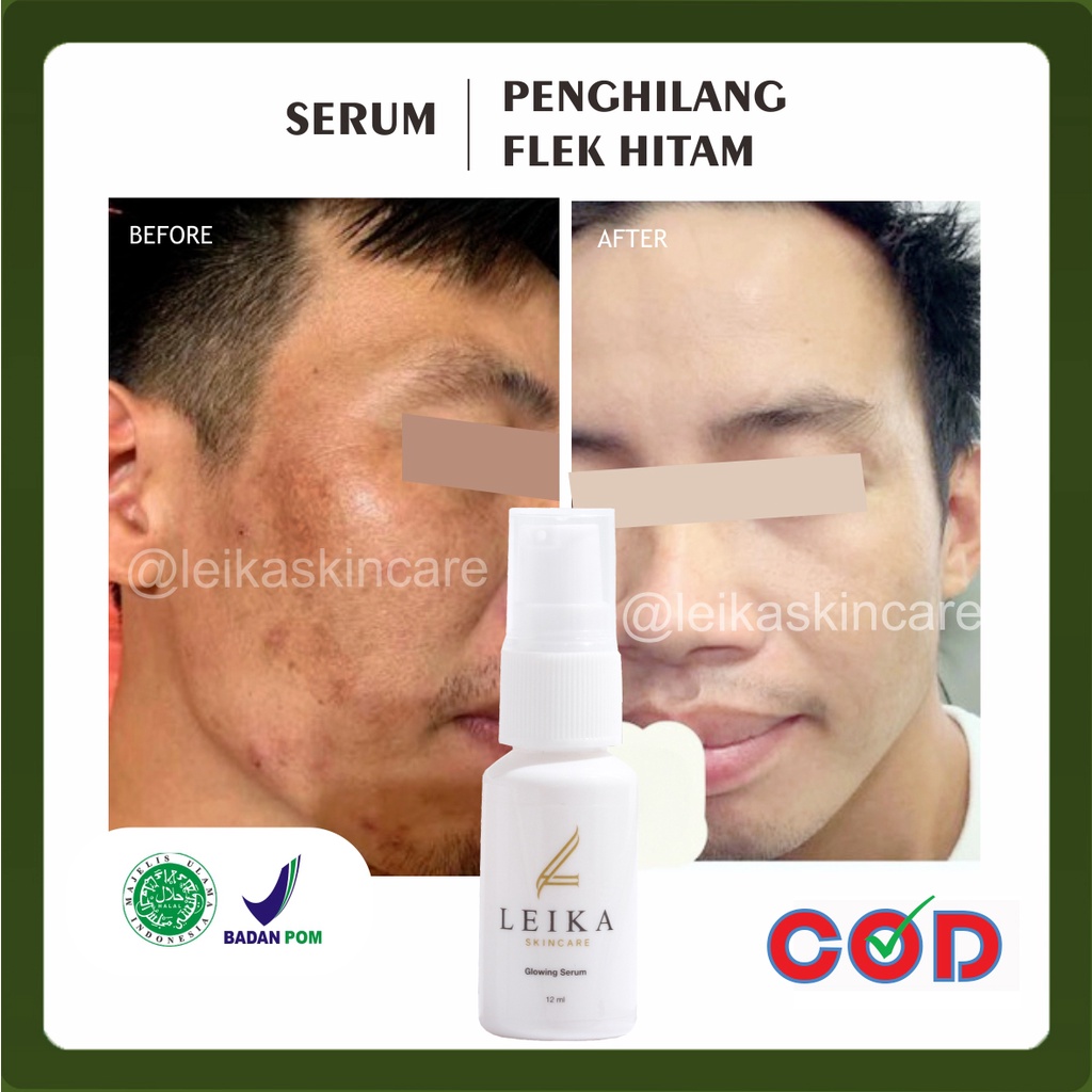 PROMO LEIKA SERUM PENGHILAN FLEK HITAM WAJAH PRIA TERBUKTI AMPUH MENGHILANGKAN FLEK HITAM PADA WAJAH