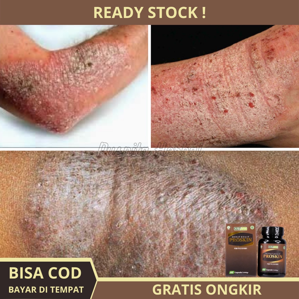 Obat Eksim Kering Menahun - Obat Eksim basah - Obat Eksim Parah - Eksim Kering Basah Psoriasis - Ker