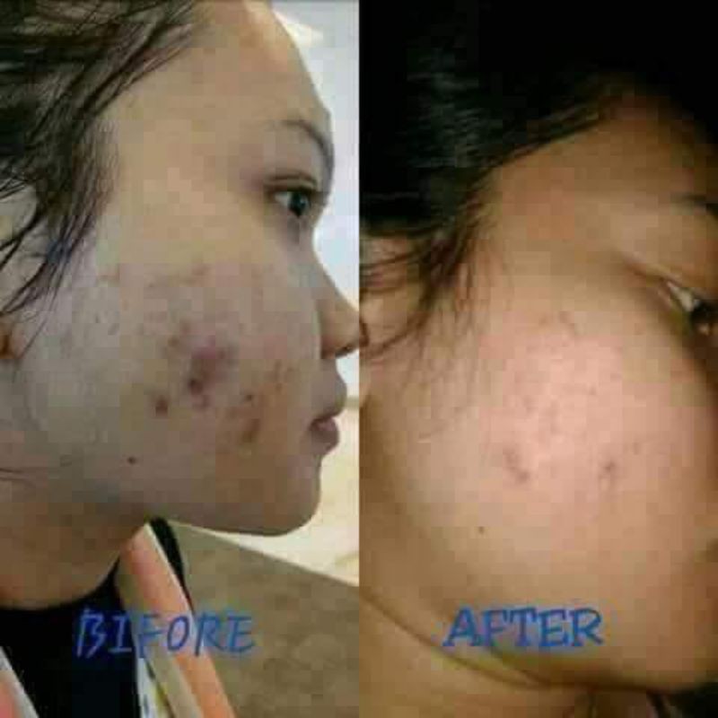 Moreskin Anti Acne Penghilang Jerawat