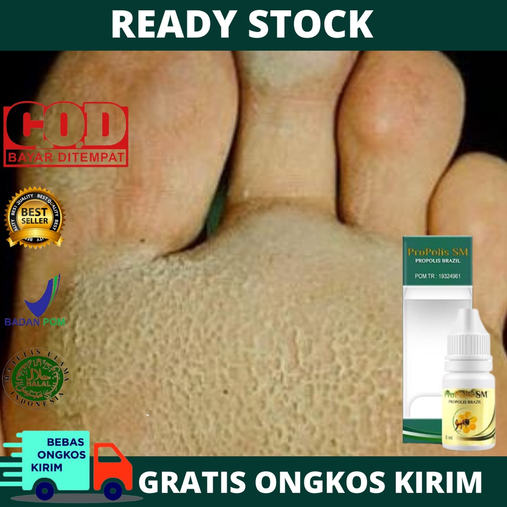 Obat Telapak Kaki Rayapan, Kaki Bolong Bolong Seperti Kena Rayap, Penghilang Kaki Rayapan