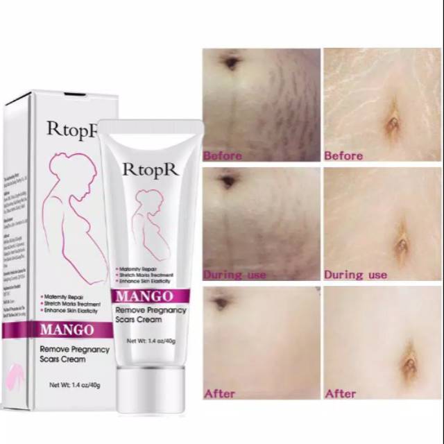 cream yang bagus untuk stretch mark