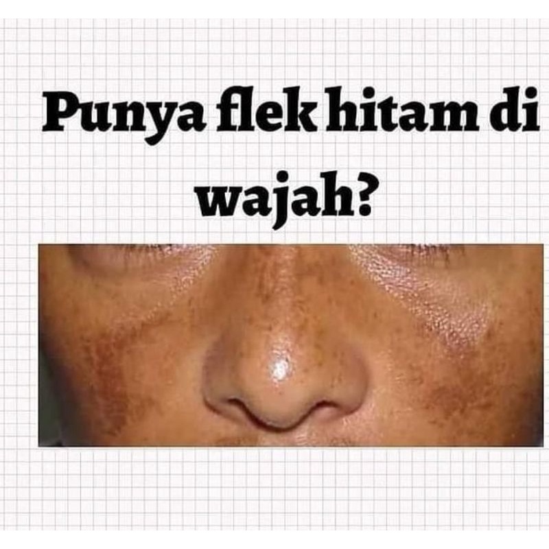 KRIM FLEK HITAM / AMPUH ATASI FLEK HITAM / SOLUSI FLEK HITAM / SR12 UTK FLEK HITAM / SR12 SPOT ESSEN