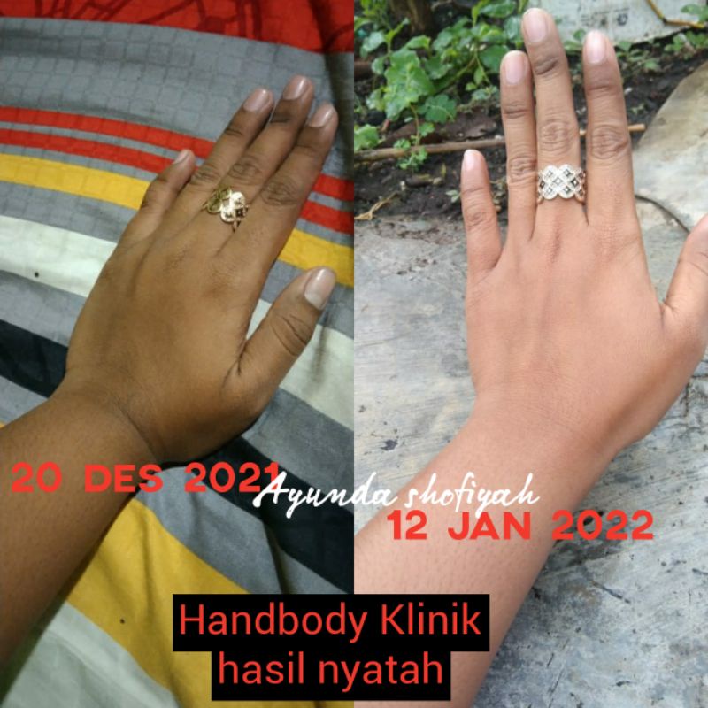 HB KLINIK HANDBODY WHITENING ( FOTO HASIL REAL ADMIN KAMI)