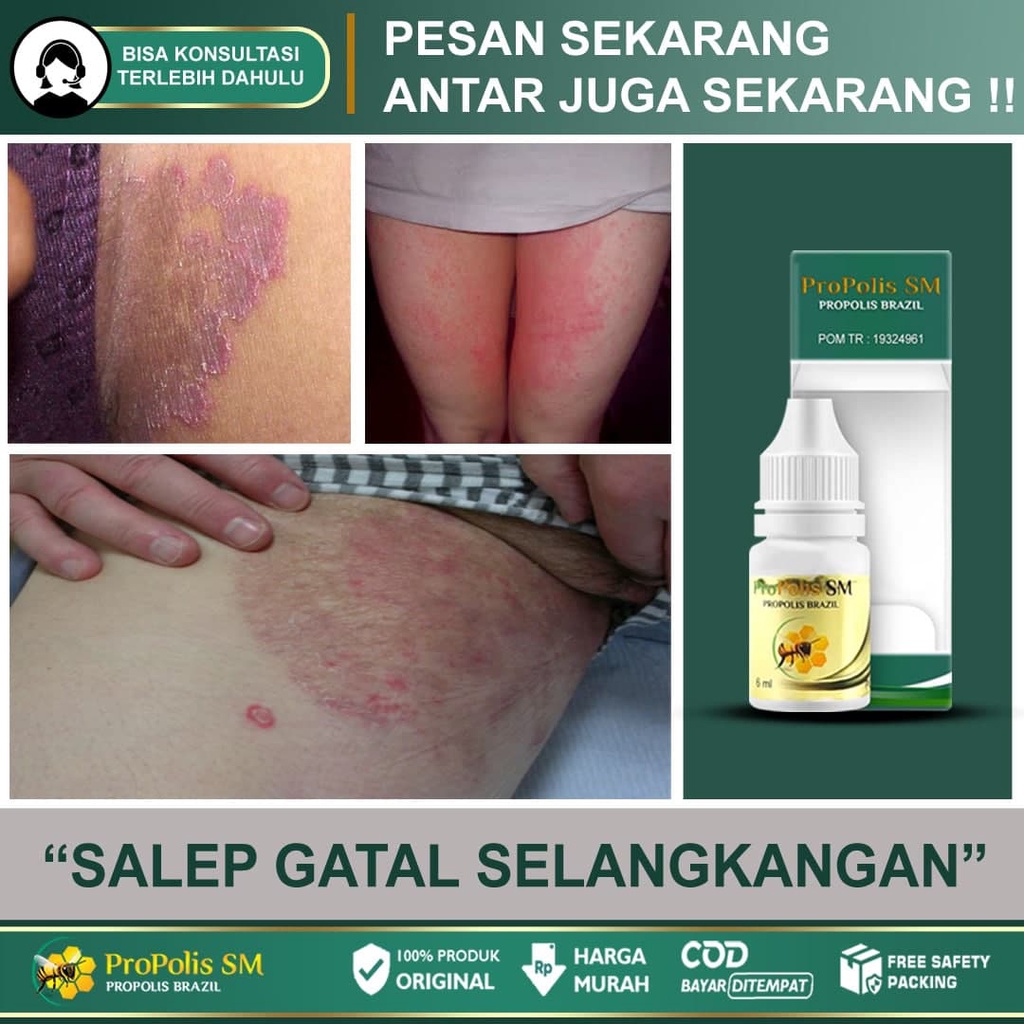 

Salep Gatal Selangkangan Anak Dan Dewasa Obat Masalah Kulit Gatal Dan Hitam Eksim Kurap Panu Scabies Kutu Air Atasi Dengan Propolis SM 100% Original Bisa COD & GRATIS ONGKIR