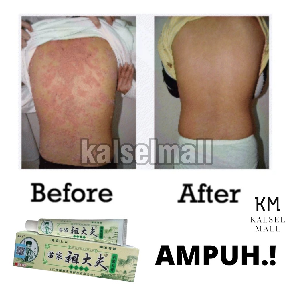 SALEP OBAT SALAP CREAM GATAL 100% ORIGINAL ZUDAIFU UNTUK ALERGI GATAL KULIT JAMURAN JERAWAT EKSIM PSOARISIS KUDIS PANU KURAP PANUAN SKABIESORI HERBAL EKSIM JAMUR KUTU AIR KURAPAN KEPUTIHAN SELANGKANGAN HERPES CINA ZHUDAIFU PALING AMPUH ZUDAIPU GATALAN