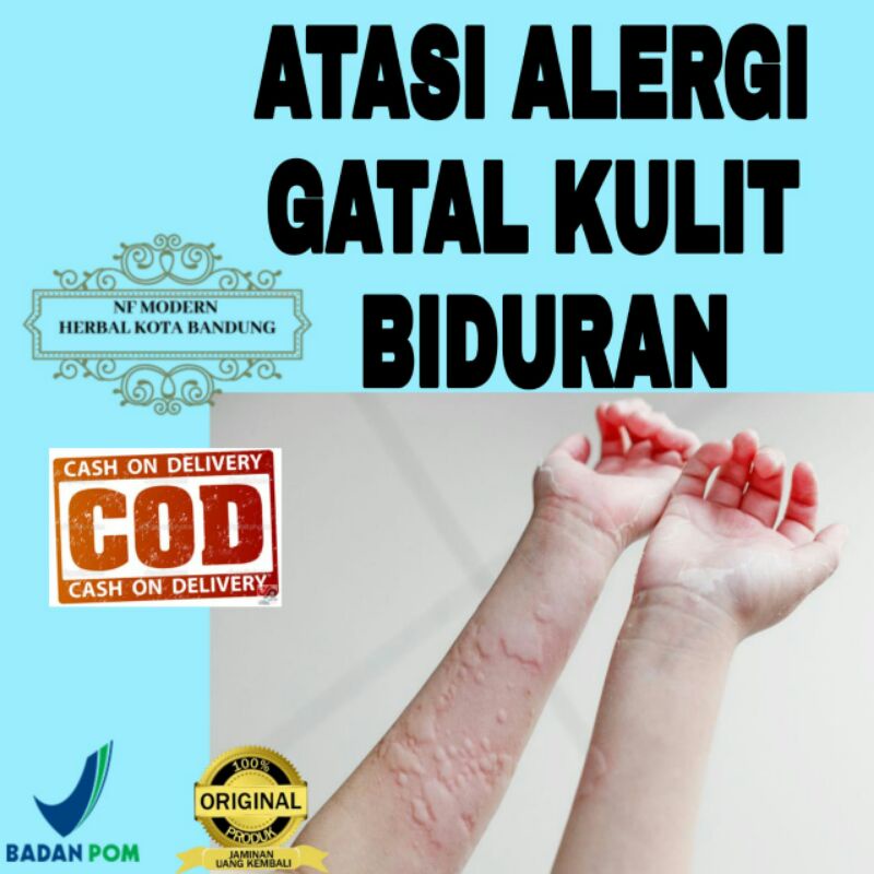 Obat untuk biduran