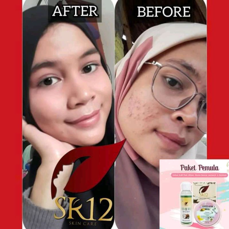 Paket pemula sr12 Berjerawat Sensitif Berminyak Skincare Jerawat Aman BPOM Obat Jerawat