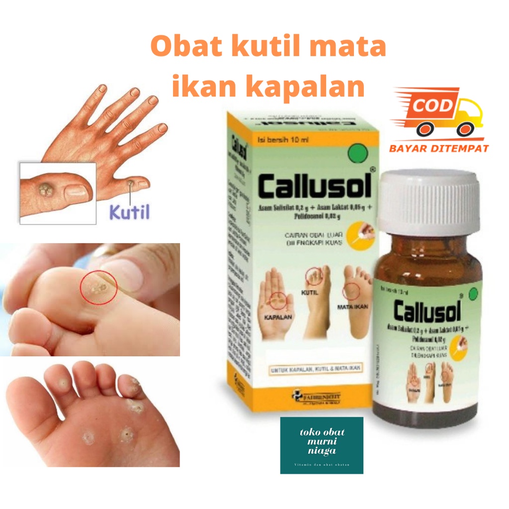 Callusol Obat Kutil calusol Mata Ikan kapalan Kulit Keras bisul