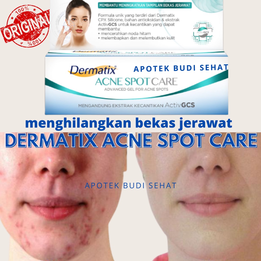 Dermatix Acne Spot Care Obat Hilangkan Bekas Jerawat Obat Totol Jerawat Ampuh 7gr Acne Scar Acne Ski