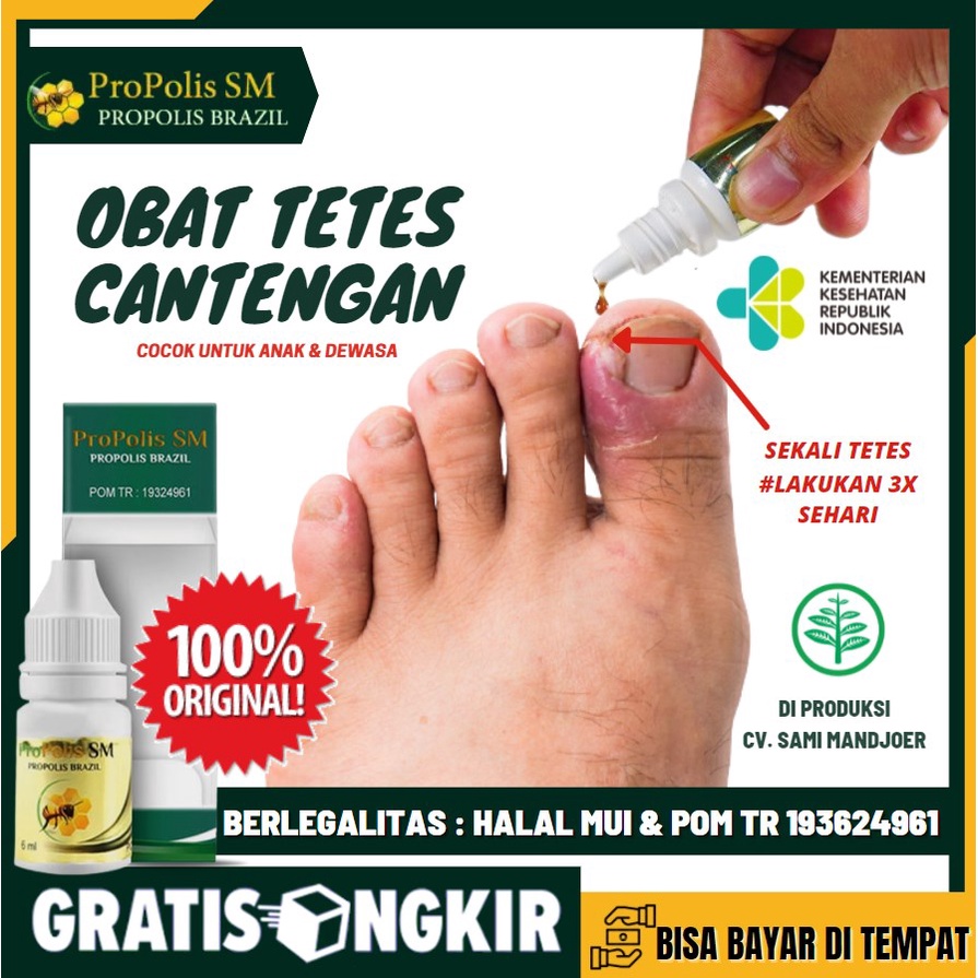Obat Khusus Cantengan Parah, Cantengan Kuku Jempol Kaki ,Cantengan Bengkak Bernanah Propolis Alami