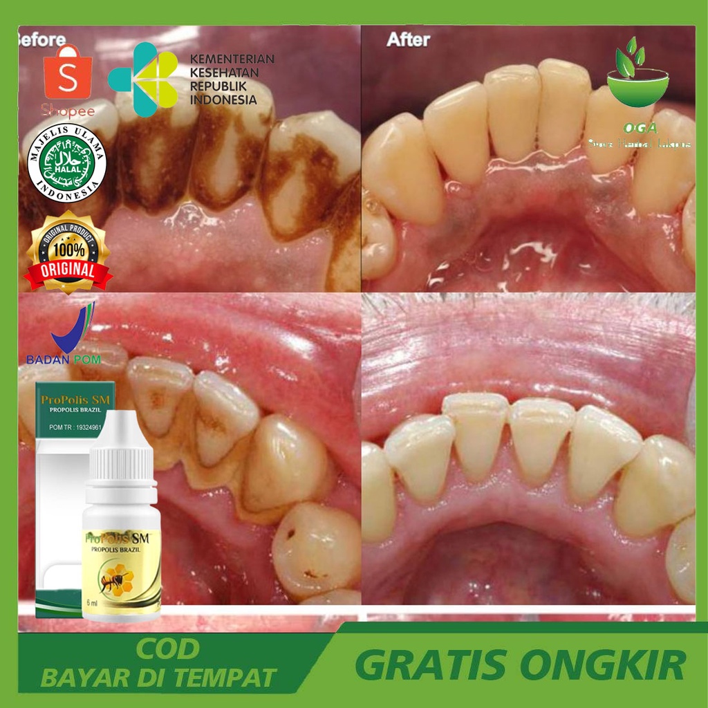 OBAT PEMUTIH GIGI DAN PENGHILANG KARANG GIGI | SERUM PEMUTIH | PENGHILANG KARANG GIGI | PROPOLIS SM 