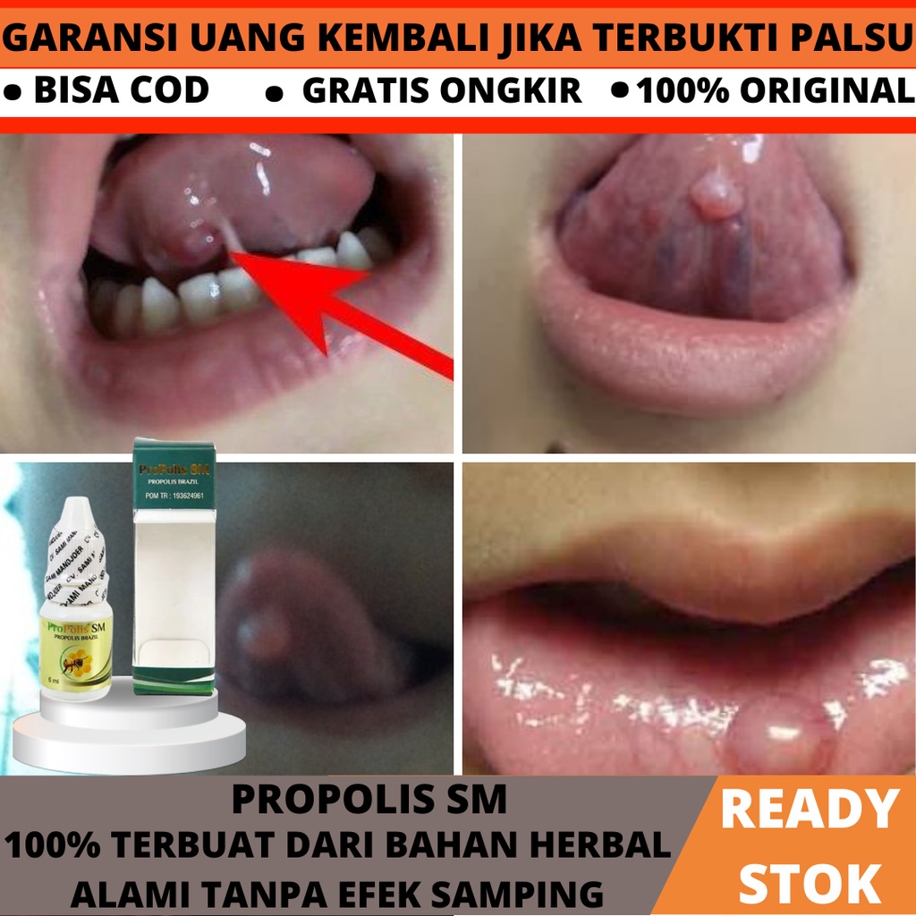 PROPOLIS SM 100 % ORIGINAL BPOM & HALAL, Obat Kelenjar Mukokel, Obat Herbal Pengempis Benjolan di  L