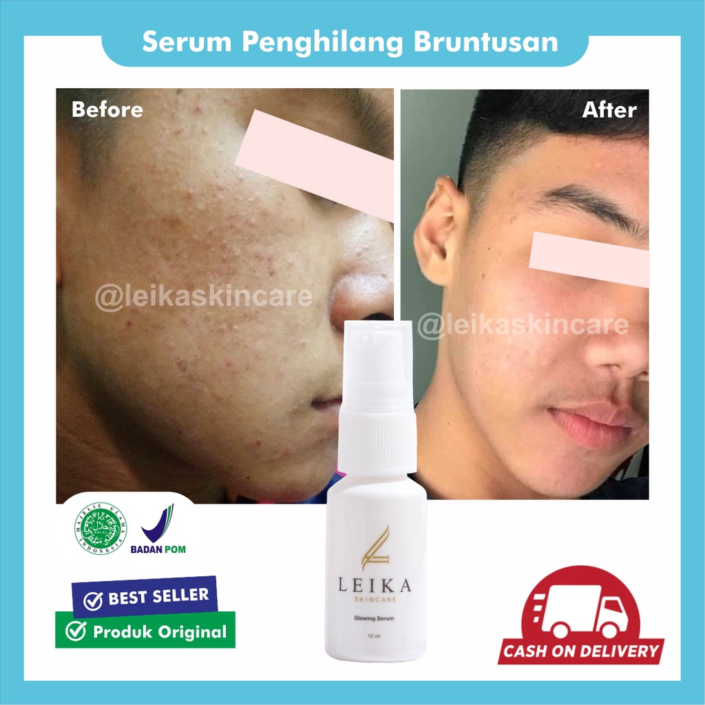 Serum Penghilang Bruntusan  AMPUH Serum Bruntusan Obat Jerawat Dan Bekas Jerawat Serum Jerawat Dan B