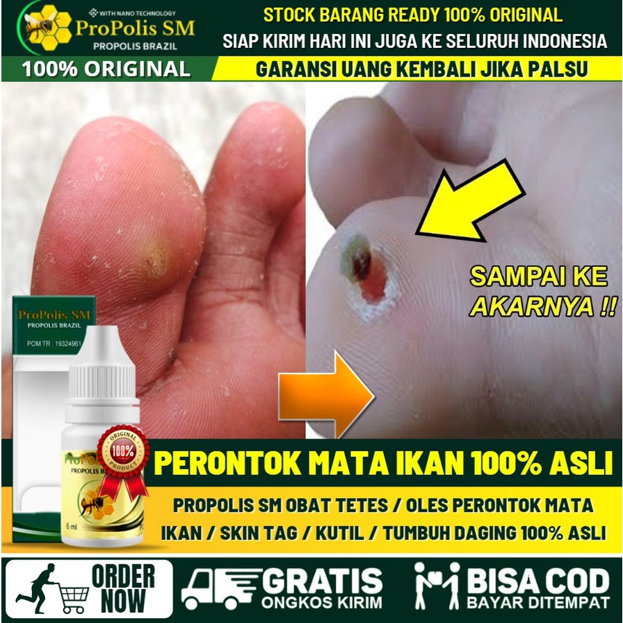 OBAT MATA IKAN DI TELAPAK KAKI, OBAT MATA IKAN DI TELAPAK TANGAN, OBAT MATA IKAN KALUSOL, OBAT MATA 
